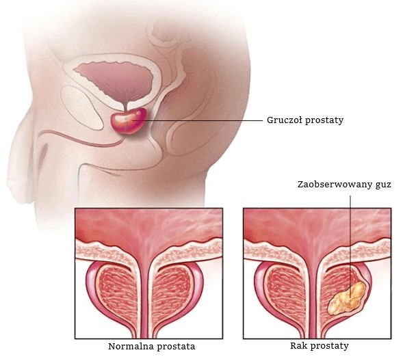 zacewnikowany pacjent i mokry pampers